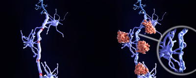 Autoimmune Diseases