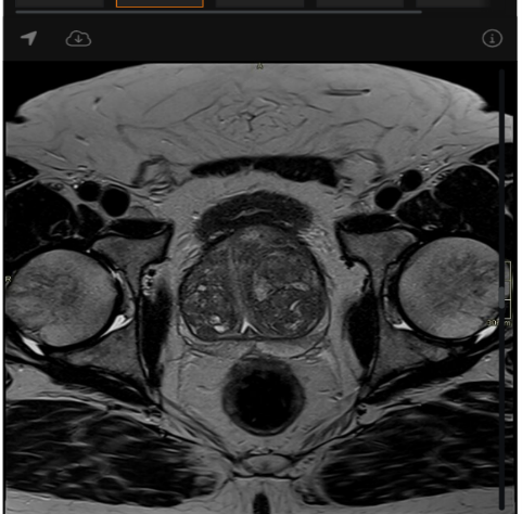 MRI of Benign Prostatic Hyperplasia